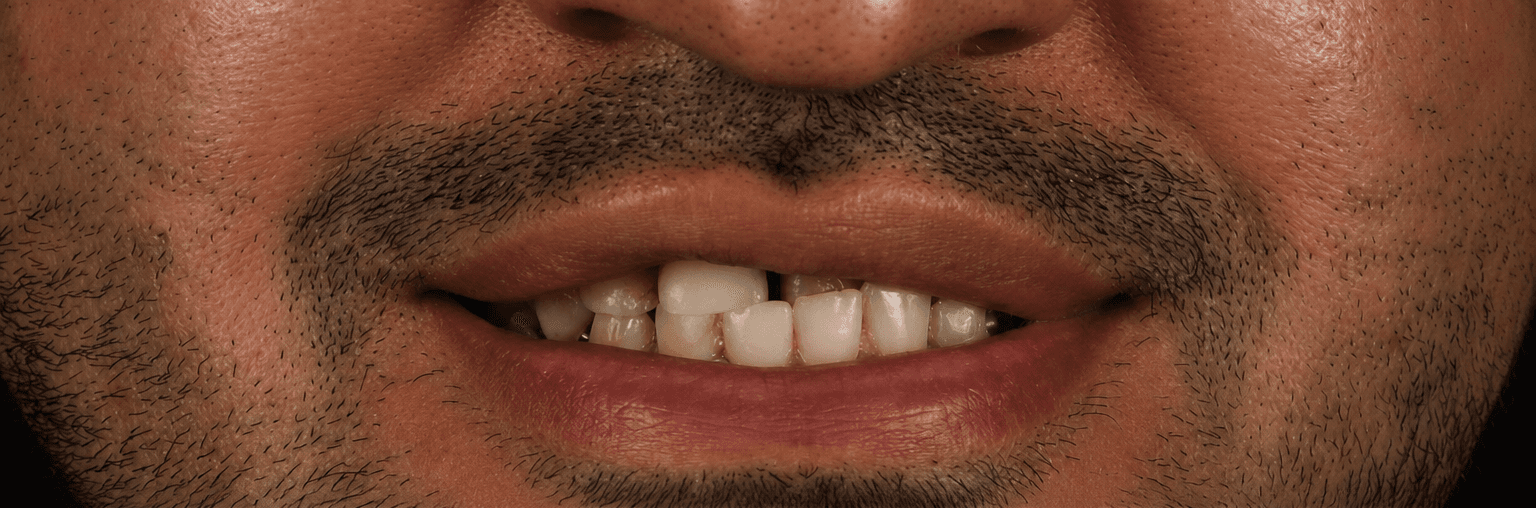 Before treatment