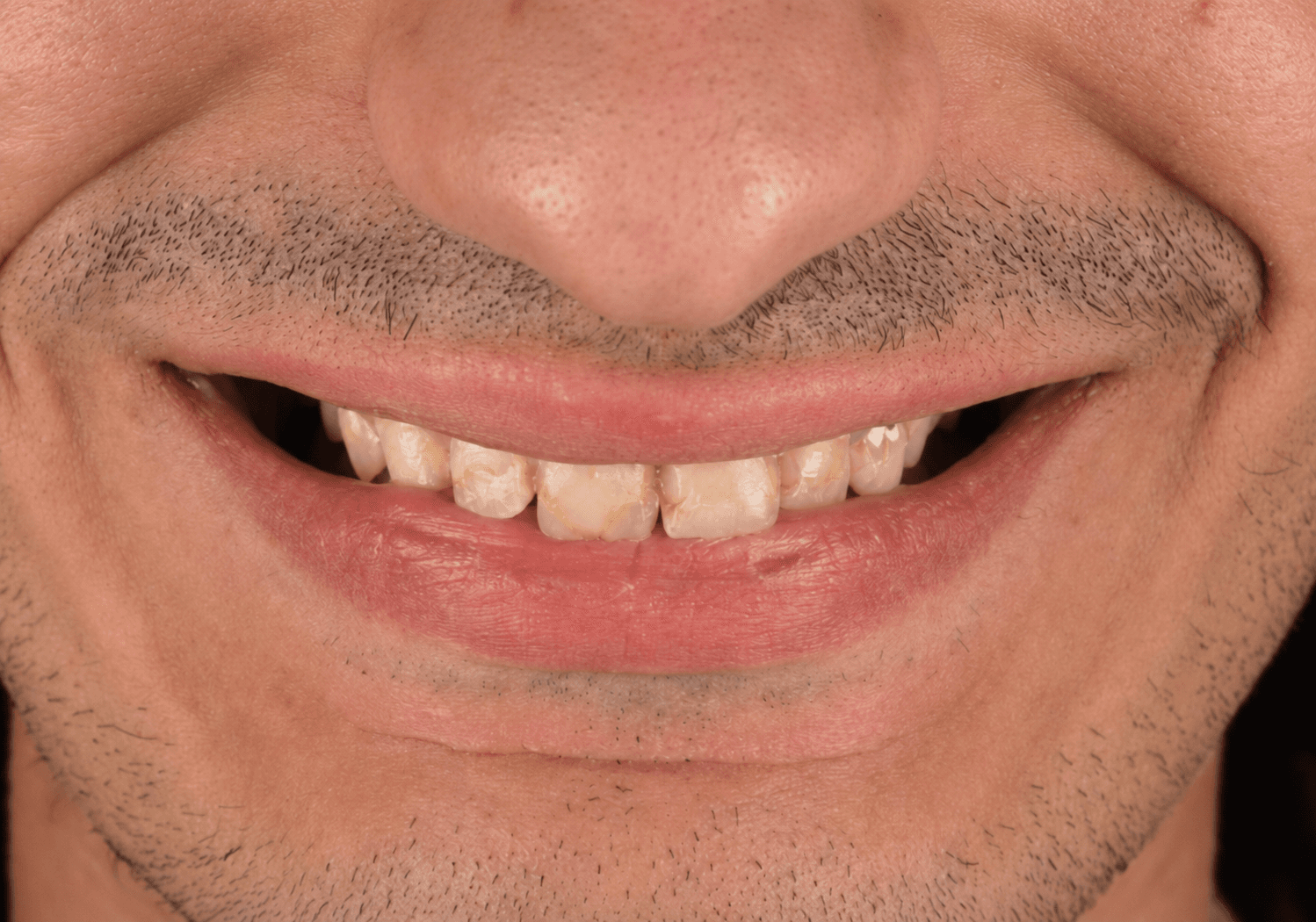 Before treatment