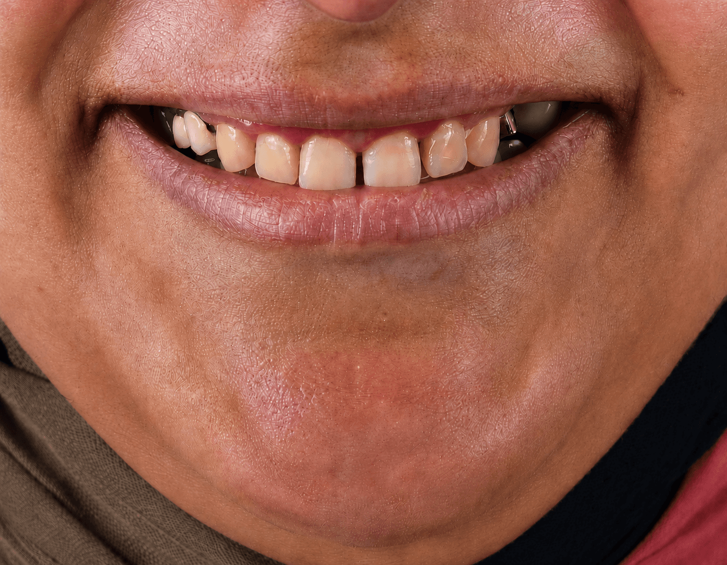 Before treatment
