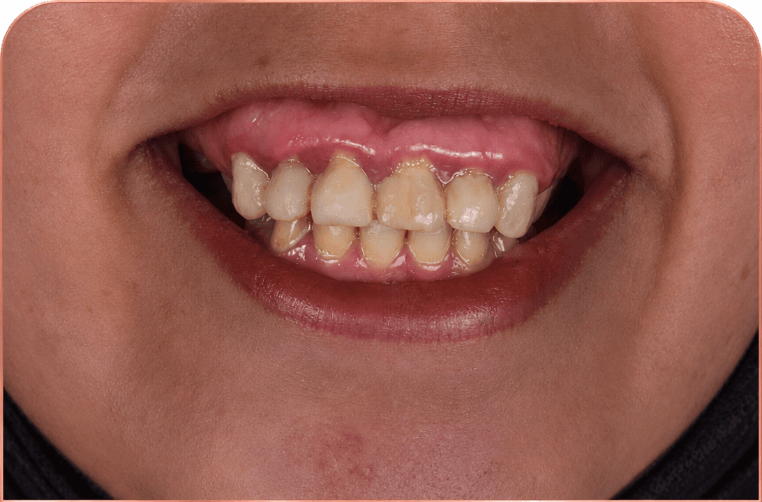 Before treatment